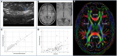 Fewer neurocognitive deficits and less brain atrophy by third ventricle measurement in PLWH treated with modern ART: A prospective analysis